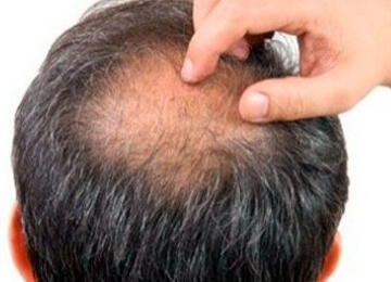 Calvície e Queda de Cabelo 