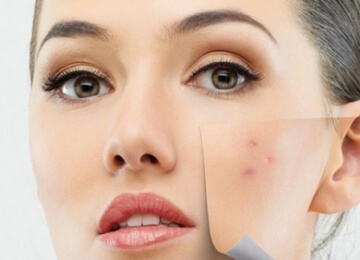 Correção de Cicatrizes de Acne