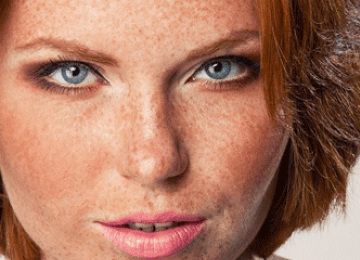 Luz Intensa  Pulsada